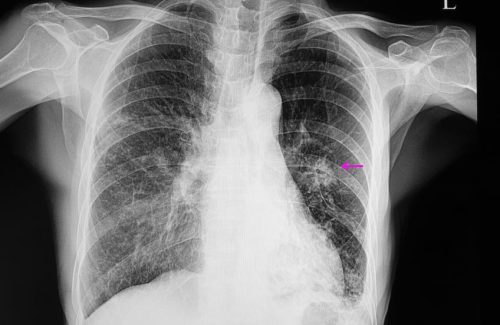 A chest xray film of a patient with right middle and lower lobes pneumonia, left lower lobe pneumonia, and left middle lung nodule.