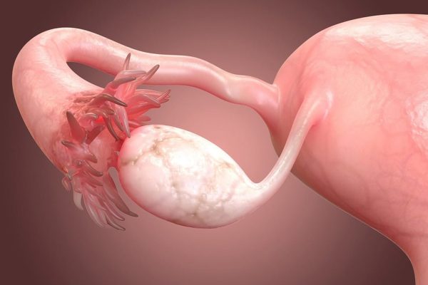 Yumurtalık Kanserivv