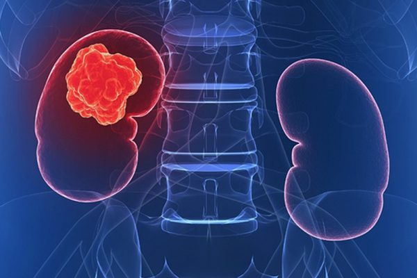 bobrek-kanseri