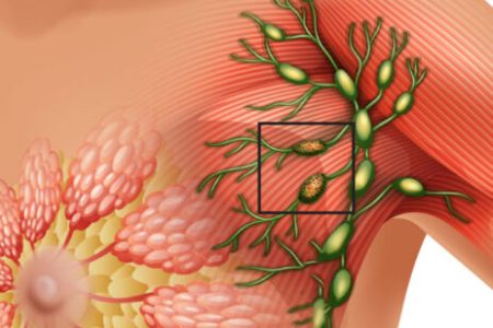 kanser-evreleri-463x348