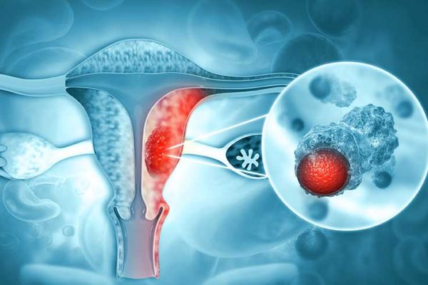 rahim-kanseri-belirtileri-nelerdir-6-onemli-belirti-2978